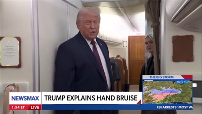 Trump’s bruising caused by daily aspirin use: Dr. Crandall | Newsline